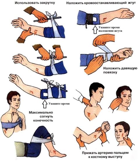Остановка кровотечения перед накладыванием шины