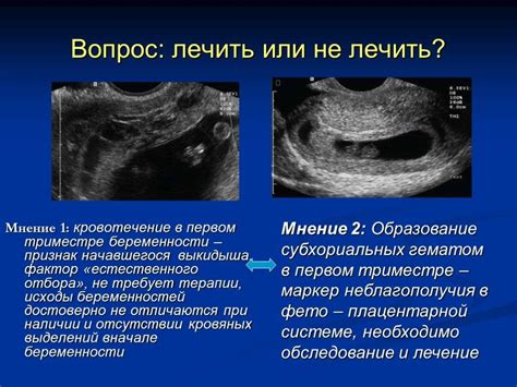 Отслойка плаценты во втором триместре: частые причины