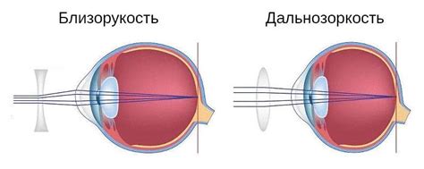 Очки и линзы: долгосрочные последствия