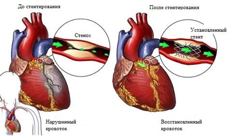 Плюсы и минусы шунтирования после стентирования