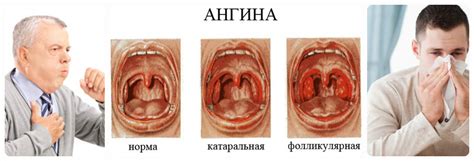 Подготовка к удалению миндалины