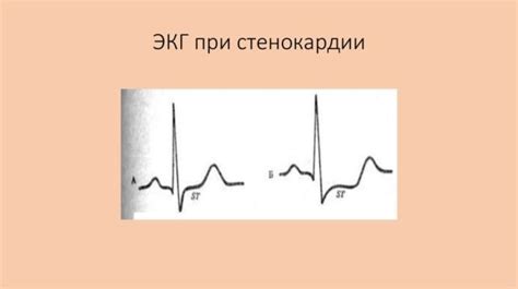 Польза парильной процедуры при стенокардии