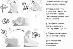 Популярные способы снятия головокружения