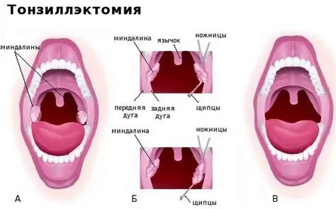 Постоперационный уход после удаления миндалины