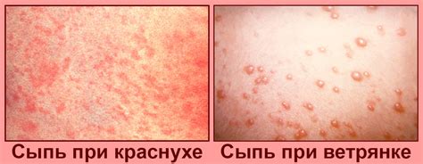 Почему возникает сыпь на коже при повышении температуры?