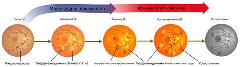 Предотвращение развития диабетической ретинопатии