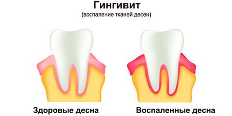 Преимущества массажа дёсен при шишках