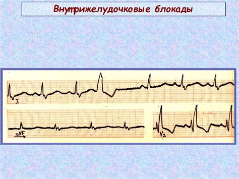 Примеры успешного занятия спортом с нарушением внутрижелудочковой проводимости