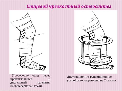 Принципы лечения переломов