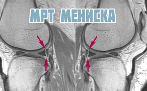 Принципы лечения разрыва мениска