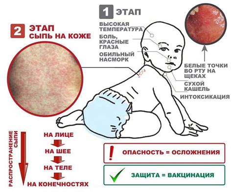 Причины отсутствия повышения температуры при протекании кори