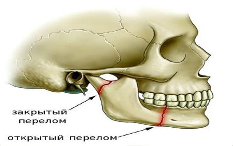 Причины повреждения челюсти