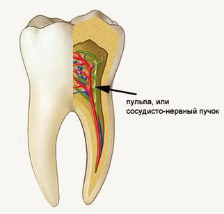Причины удаления нерва под коронку