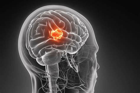 Прогноз и стадии развития опухоли головного мозга из глиоза
