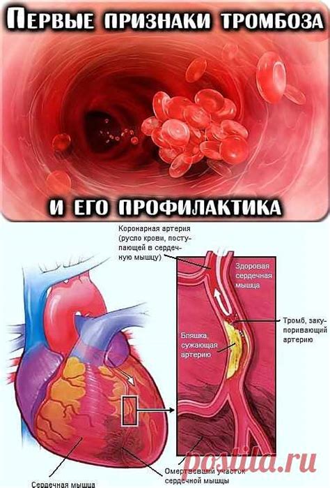 Профилактика тромбоза: здоровые сосуды и кровообращение