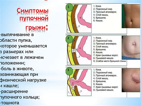 Пупочная грыжа у ребенка: что нужно знать