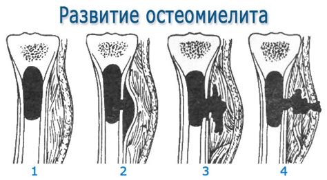 Развитие остеомиелита