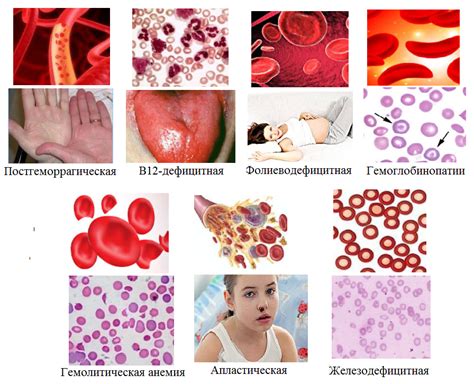 Разновидности анемии