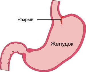 Разрыв сосуда как причина кровотечения при зачатии