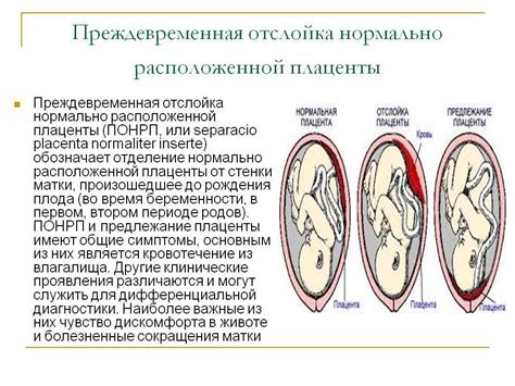 Риск увеличения отслойки плаценты