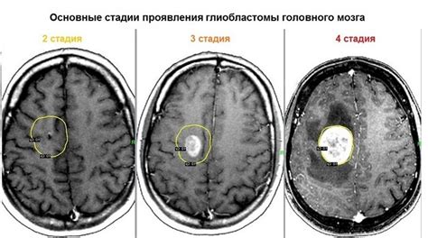 Роль глиоза в развитии опухоли головного мозга