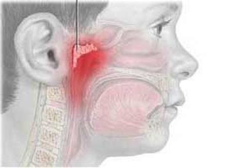 Симптомы аденоидов у ребенка: как их распознать?
