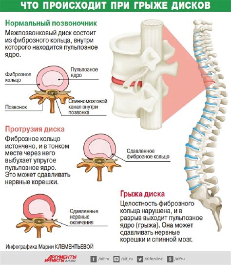 Симптомы и причины грыжи у взрослых