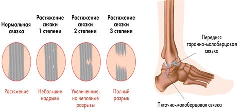 Симптомы растяжения связок: как распознать проблему