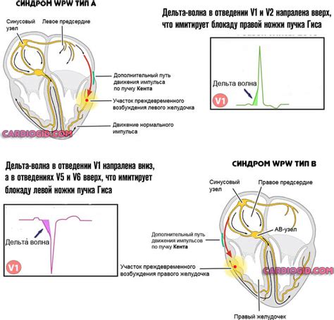 Синдром ВПВ: исчезнет ли сам по себе?