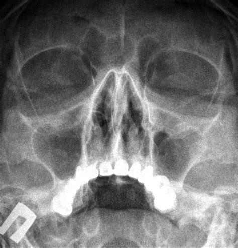 Систематический подход к рентгену пазух носа