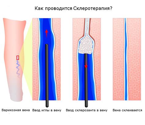 Склеротерапия как эффективный метод лечения варикозного расширения вен на ногах