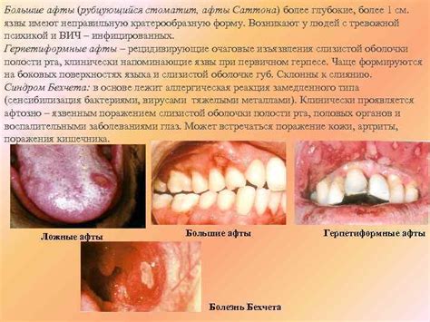 Сновидения о порченых зубах: предупреждение о возможных заболеваниях полости рта