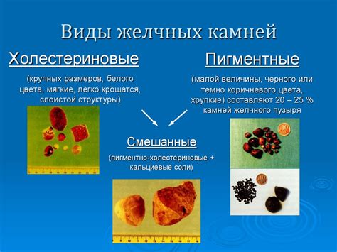 Советы по предотвращению появления желчных камней