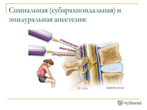 Спинальная анестезия при родах