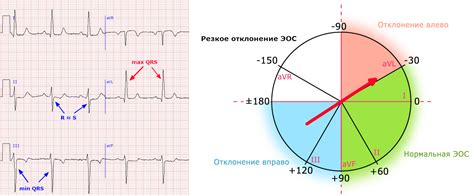 Способы определения употребления парить по ЭКГ