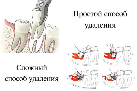 Способы разрешения образа сновидческой сцены вырывания зуба с проявлением крови