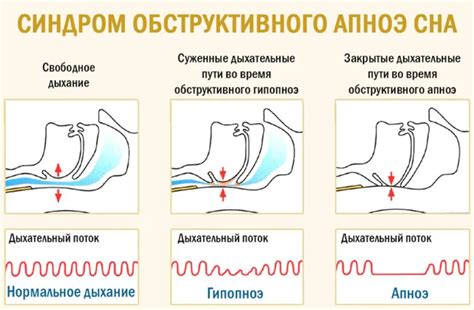 Техники и упражнения для предотвращения храпа