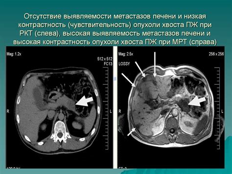 Типы злокачественных опухолей поджелудочной железы и их характеристики