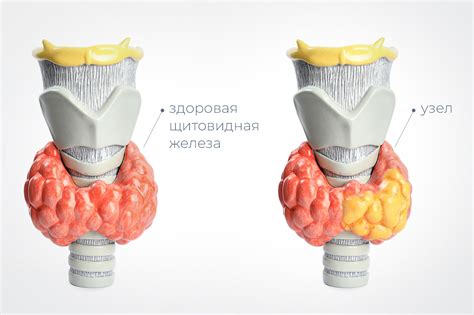 Узлы в щитовидной железе