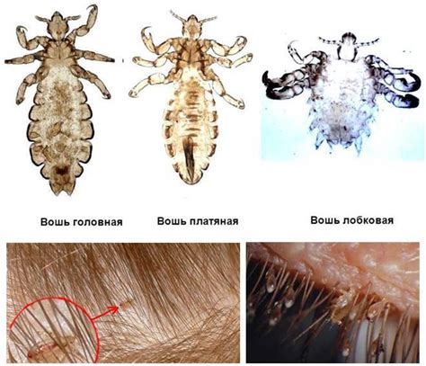 Что значат сны о насекомых: воши и гниды