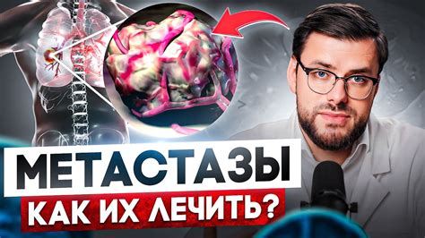 Что такое метастазы и как их обнаружить во время операции?