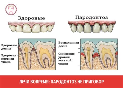 Что такое пародонтоз