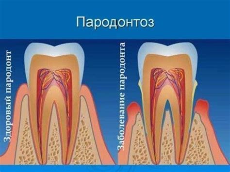 Что такое пародонтоз и как облегчить его с помощью ирригатора