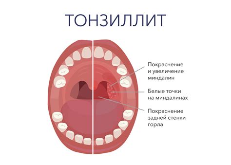 Что такое тонзиллит