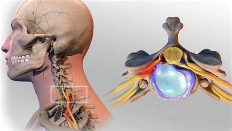 Шейная грыжа: причины и симптомы
