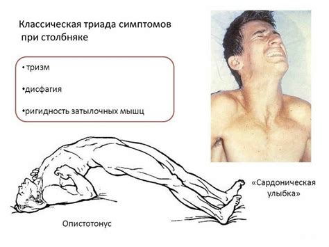  Как защитить себя от заражения столбняком через занозу? 